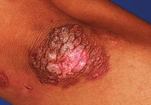 Tuberkulosis Verukosa Kutis